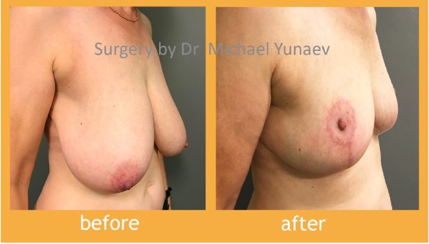 Turn To A Specialist For A Breast Lift Procedure
