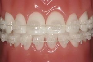 Are You Put-Off by The Thought of Using Metallic Braces? – Invisalign Comes to The Rescue