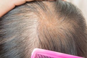 Minoxidil: A Reliable Treatment for Hereditary Baldness!