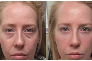 Enhance Your Appearance With Tear Trough Filler
