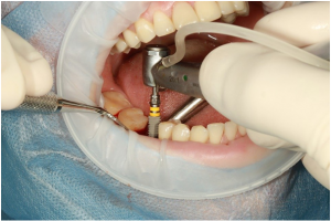 Your Quick Guide to Dental Implant Complications