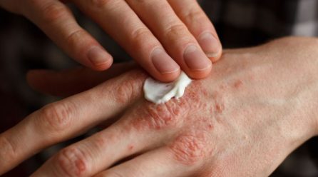 Can you trust homeopathy treatment for psoriasis today?