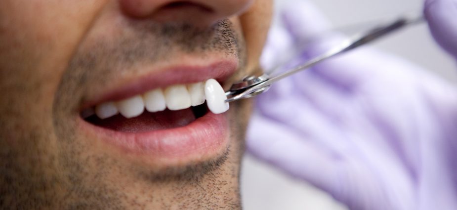 Tips for Taking Care of Dental Veneers