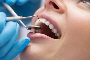All You Need to Know About Dental Bonding