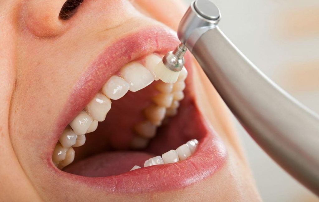 What to Know About Professional Teeth Cleaning