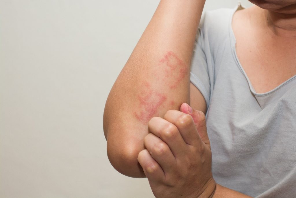 Reasons You Should Take An Allergy Test