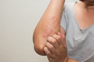 Reasons You Should Take An Allergy Test