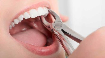 5 Reasons to Seek Professional Tooth Extraction