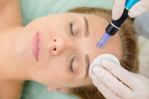 5 Surprising Facts Concerning the Microneedling Procedure