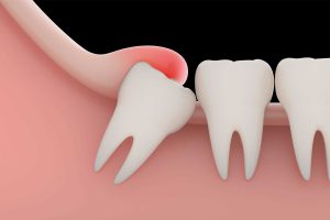 Top Six Common Problems of Impacted Wisdom Teeth