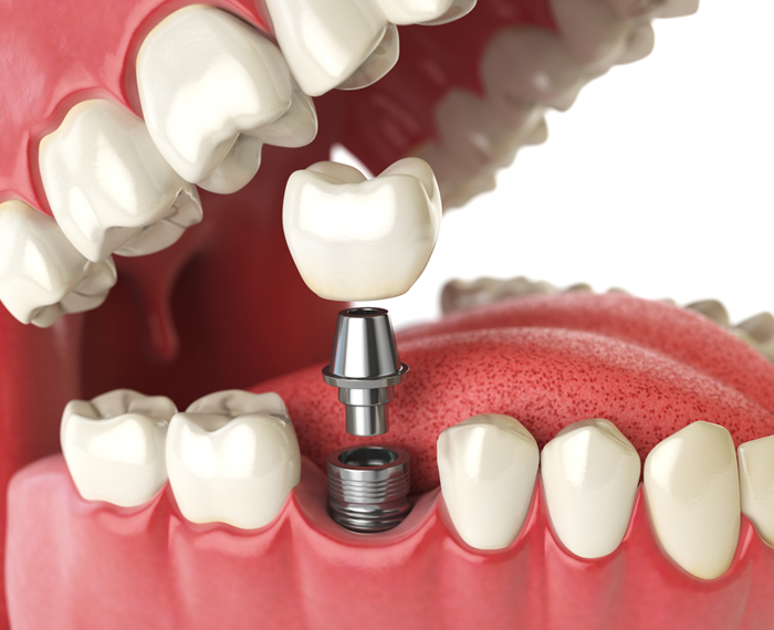 Signs That You May Need Dental Implants