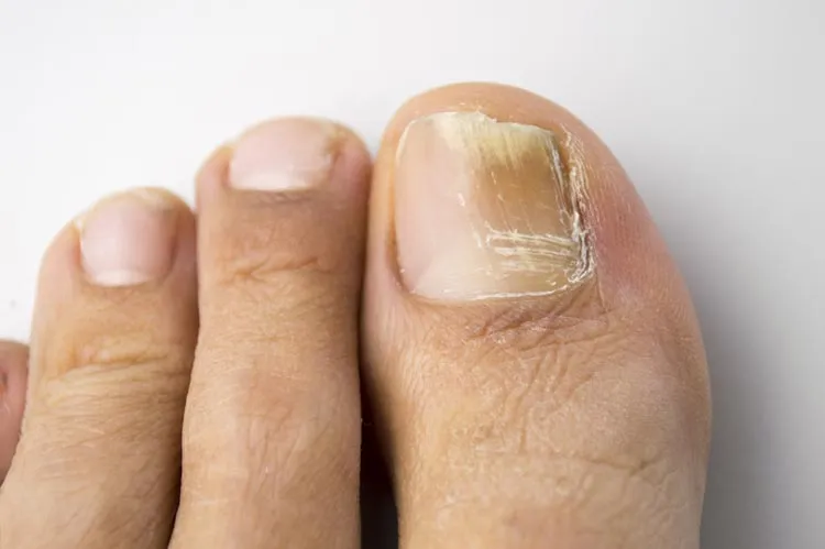 Common Tests Done To Diagnose Toenail Fungus
