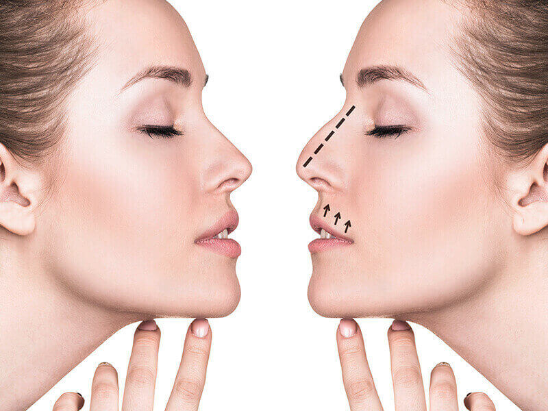 Are You A Good Candidate For Rhinoplasty? – 5 Key Factors