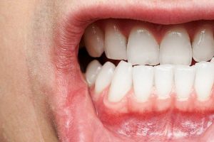How to Overcome Gum Disease