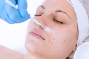 How to Prevent Damage after a Chemical Peel