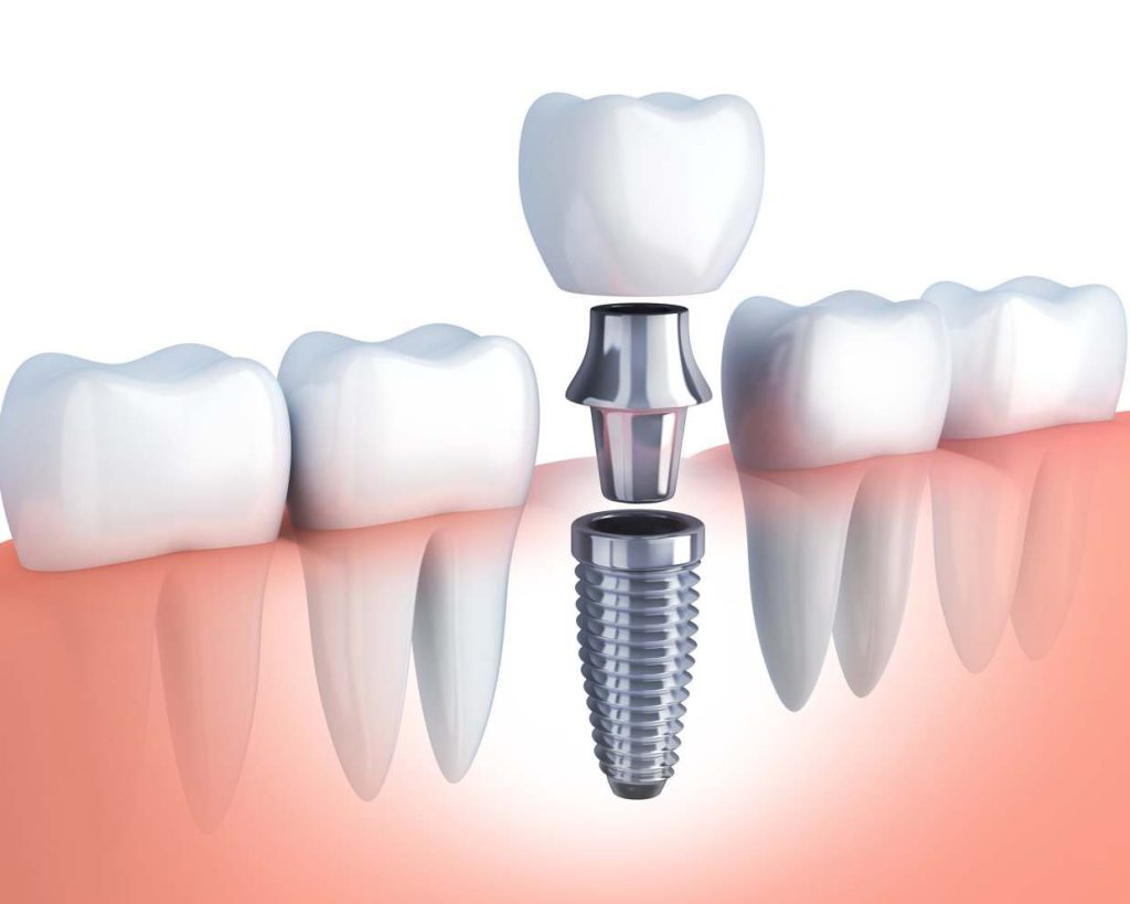 The Benefits of Dental Implants Explained