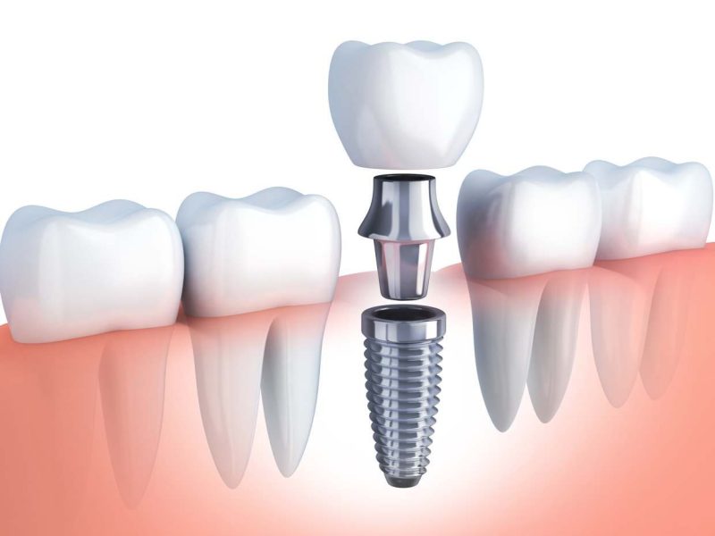 The Benefits of Dental Implants Explained