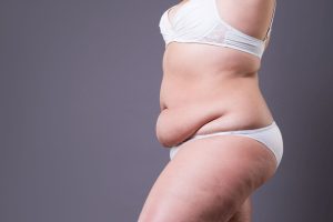 3 Essential Tips for a Smooth Tummy Tuck Healing Process