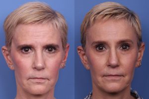 Ways in Which Facial Reconstruction Can Help?