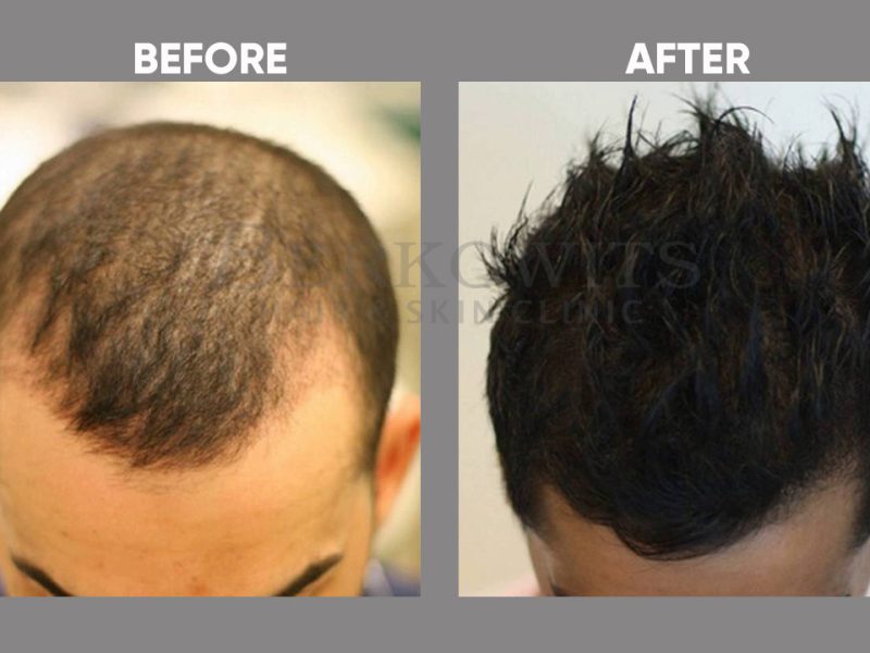 What Do You need to Know About PRP Hair Restoration?