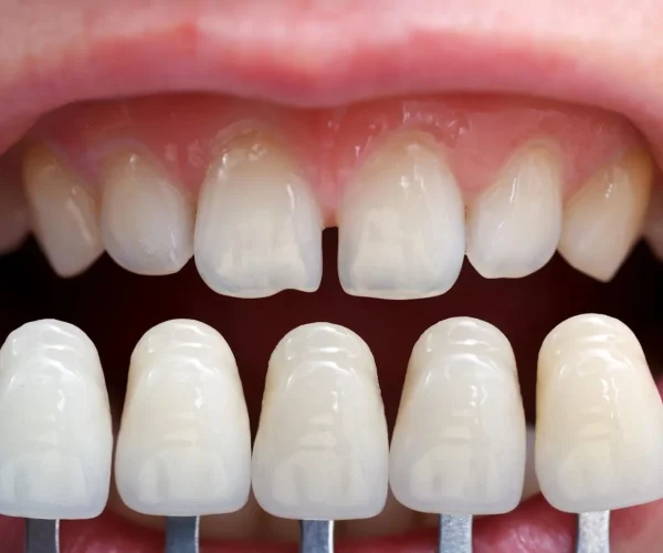 Common Misconceptions about Veneers