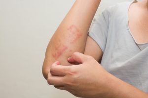Why Do Allergy Skin Tests Need to Be Performed?
