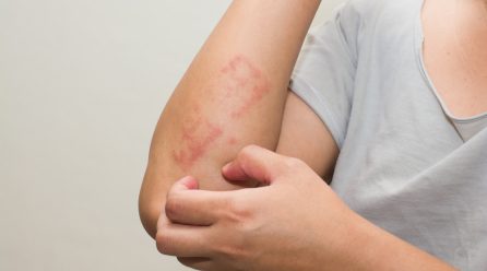 Why Do Allergy Skin Tests Need to Be Performed?