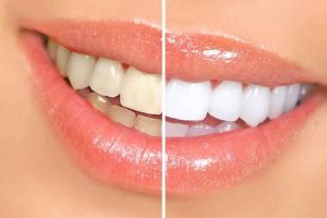 Teeth Whitening: What You Need To Know