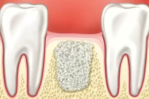 Porcelain Crowns: Modern And Innovative Solutions To Tooth Preservation 