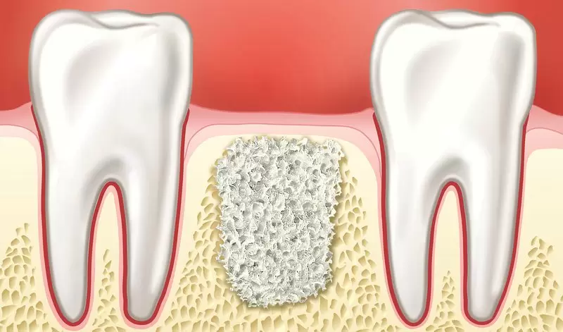 Porcelain Crowns: Modern And Innovative Solutions To Tooth Preservation 