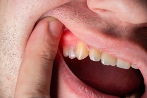 Unmasking the Pain: Exploring the Link Between Dental Abscesses and Root Infections in Powell, TN