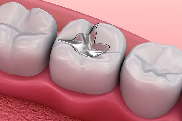 Dental Fillings