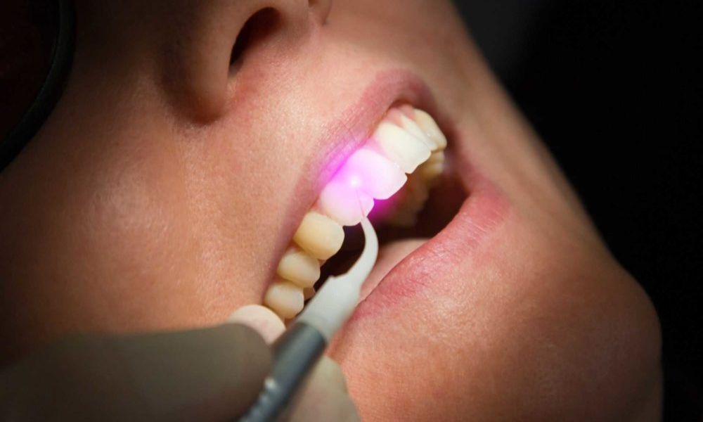 Laser Dentistry