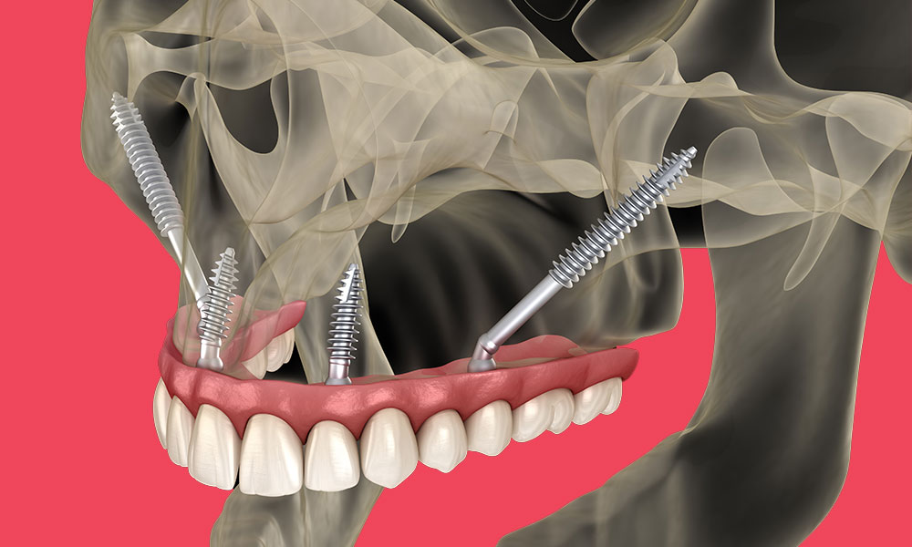 Zygomatic Implants