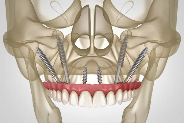 Zygomatic Implants