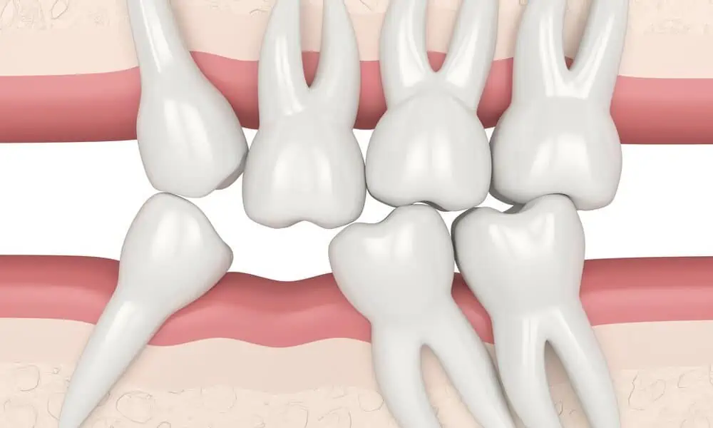 teeth repositioning