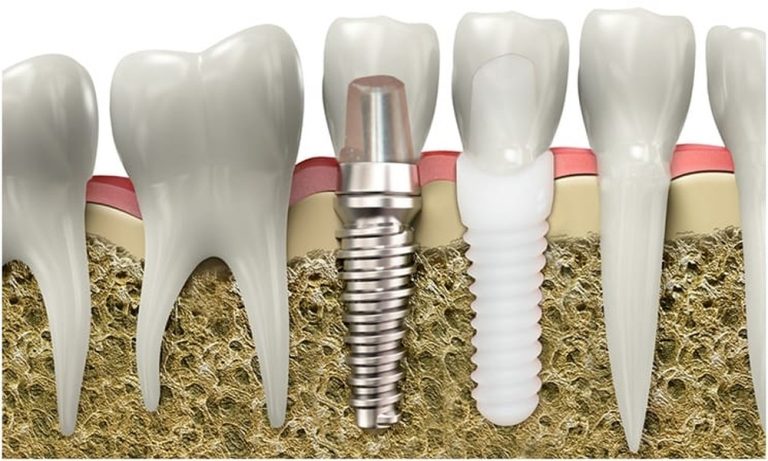 Reasons Why You Should Choose Zirconia Metal-Free Dental Implants